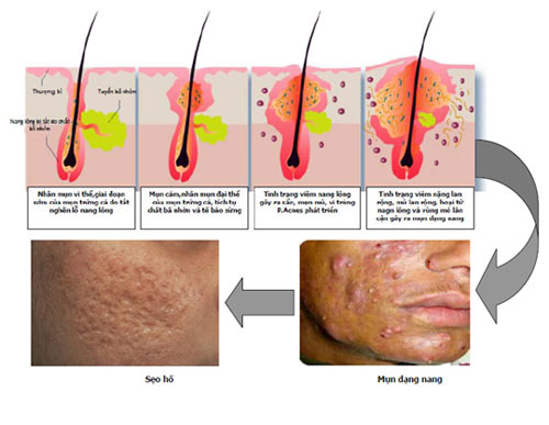 Sử dụng isotretinoin trị trứng cá cần lưu ý gì? 1